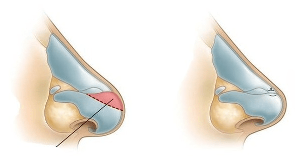 Correzione della forma del naso