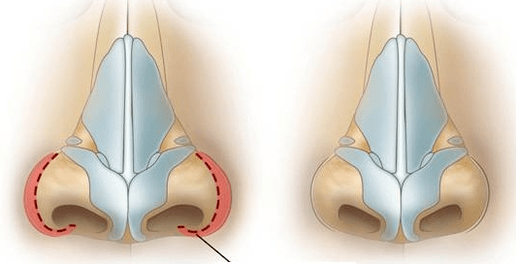 Riduzione della narice