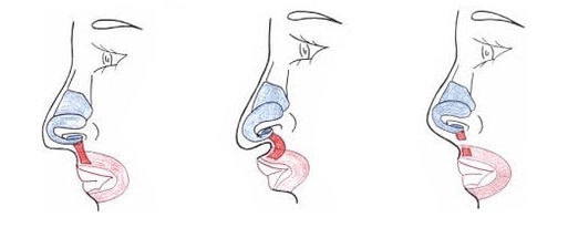 Troncamento di parte del muscolo nasale