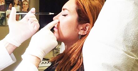 Intervento di rinoplastica con filler