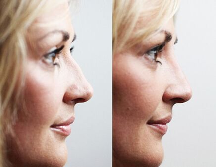 Prima e dopo rinoplastica con filler