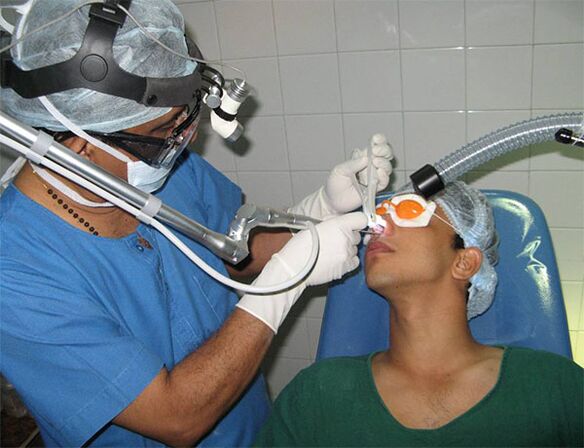 correzione del setto mediante bisturi laser