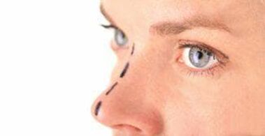 Marcatura sul naso per l'inserimento di fili cosmetici