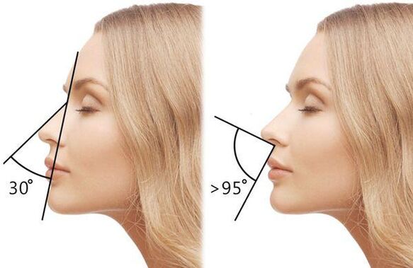 misurazione dell'angolo del naso