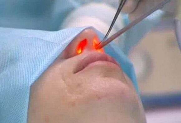 rinoplastica laser del naso