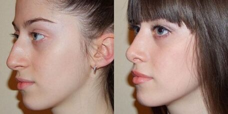 foto prima e dopo la rinoplastica nasale