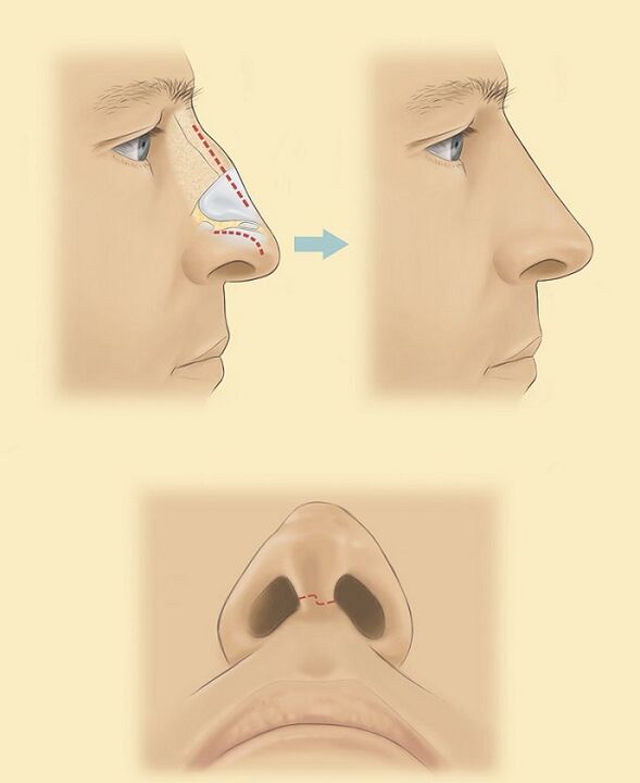 schema per rinoplastica del naso