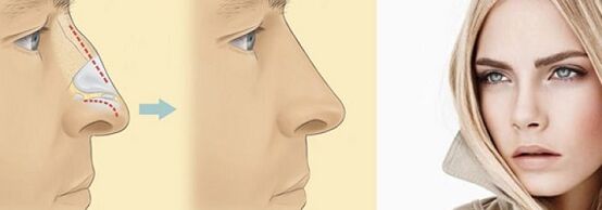 correzione della forma del naso con rinoplastica non chirurgica