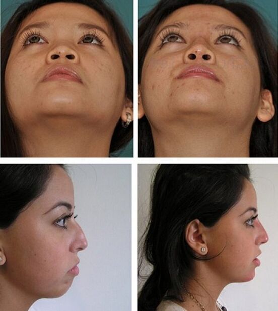 foto prima e dopo rinoplastica senza intervento chirurgico