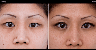 prima e dopo l'intervento agli occhi