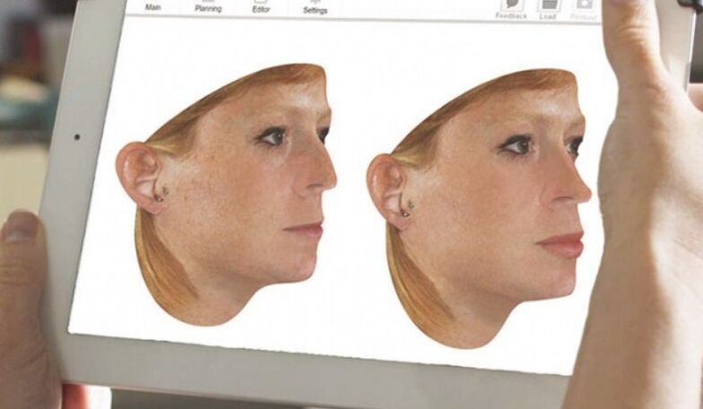 Metodo di modellazione al computer del naso prima della rinoplastica
