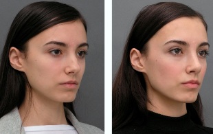 La ragazza prima e dopo rinoplastica naso